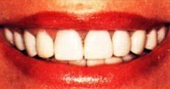Blanquamiento dental - Después