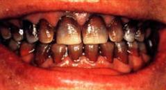 Blanqueamiento dental - Antes