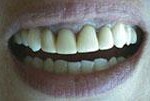 Dientes cortos o gastados (2) - Antes