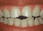 Dientes cortos o gastados - Antes Dientes cortos o gastados - Antes