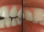 Dientes cortos o gastados Antes y Después