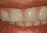 Dientes cortos o gastados - Después Dientes cortos o gastados - Después