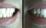 Dientes-torcidos-encimados-o-desalineados