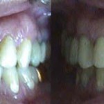 Espacios entre dientes (Diastemas)