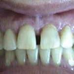 Espacios entre dientes (Diastemas) - Antes Espacios entre dientes (Diastemas) - Antes