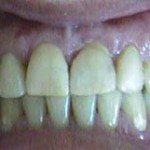 Espacios entre dientes (Diastemas) - Después Espacios entre dientes (Diastemas) - Después
