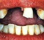 Implantes dentales (2) - Antes