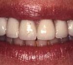 Implantes dentales (2) - Después