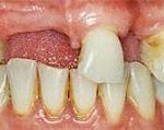 Implantes dentales - Antes Implantes dentales - Antes