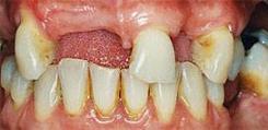Implantes dentales - Antes