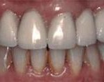 Implantes dentales - Después Implantes dentales - Después