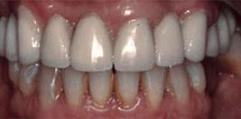 Implantes dentales - Después