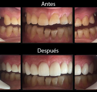 Estética Dental - Casos - Antes y Después