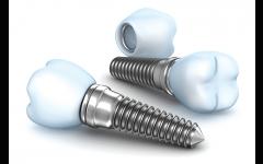 Implantes Dentales - Costos
