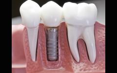 Implantes Dentales - Costos