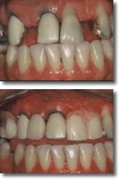 Protesis parcial removible con visibles carencias