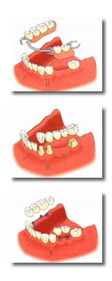 Dientes faltantes