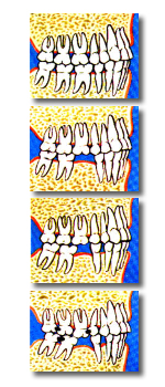 Dientes faltantes