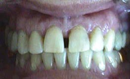Espacios entre dientes (Diastemas) - Antes