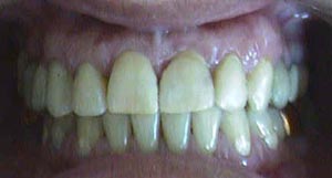 Espacios entre dientes (Diastemas) - Después
