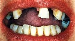 Implantes dentales (2) - Antes