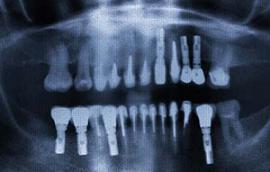 Implantes dentales (3) - Radiografía