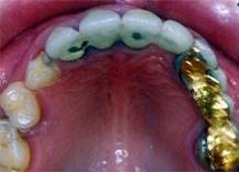 Implantes dentales (4) - Antes