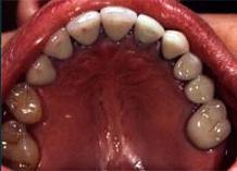 Implantes dentales (4) - Después