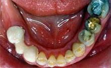 Implantes dentales (5) - Antes