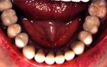 Implantes dentales (5) - Después