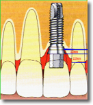 Protesis fijas vs implantes