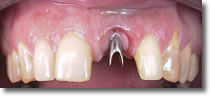 Protesis fijas vs implantes