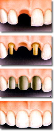 Protesis fijas vs implantes