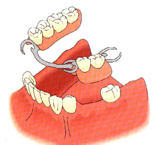 Protesis parcial removible