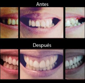 Implantes Dentales - Antes y Después