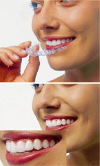 Clear Aligner