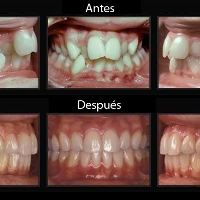 Casos - Ortdoncia Antes y Después