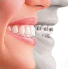 Ortodoncia sin brackets, técnica Clear Aligner