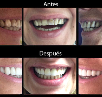 Estética Dental - Casos - Antes y Después