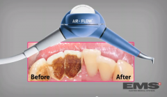 Blanqueamiento Parcial - Limpieza Profunda Air Flow