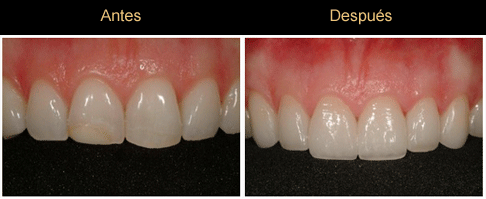Caso de blaqueamiento permanente con Carillas Estéticas