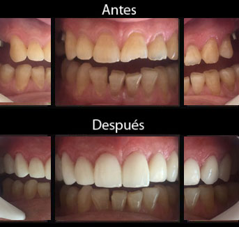 Implantes Dentales - Antes y Después